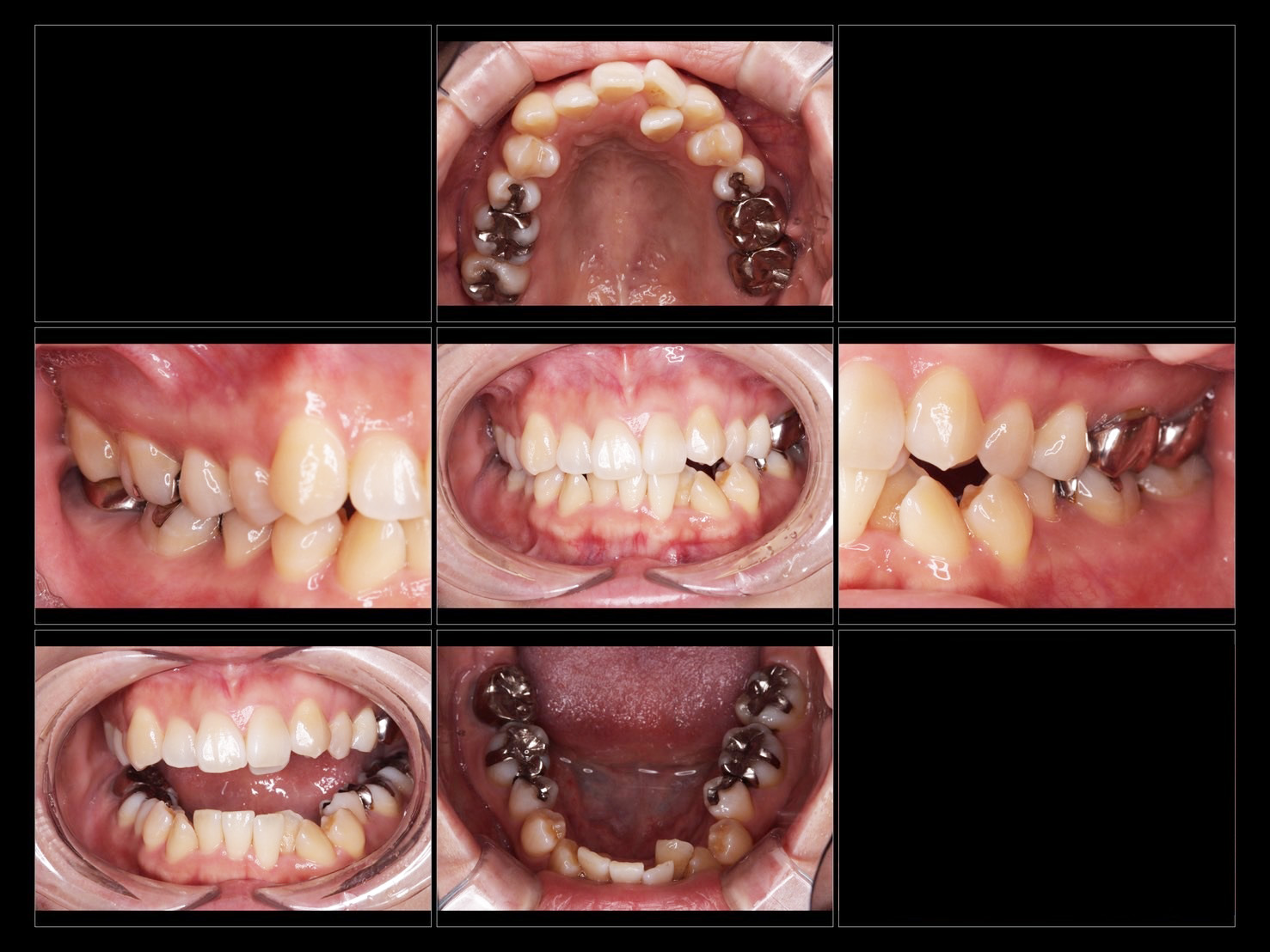 世界シェアNo.1安心と信頼のマウスピース