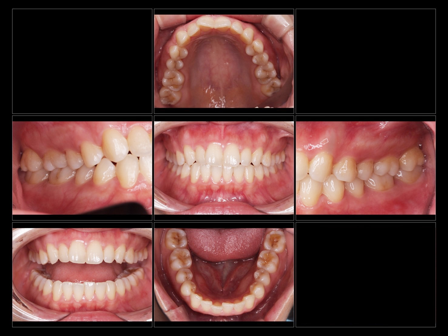 世界シェアNo.1安心と信頼のマウスピース